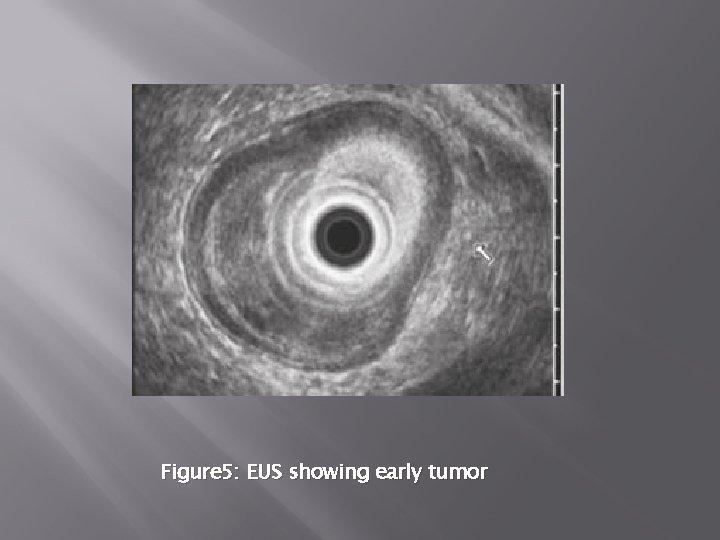 Figure 5: EUS showing early tumor 