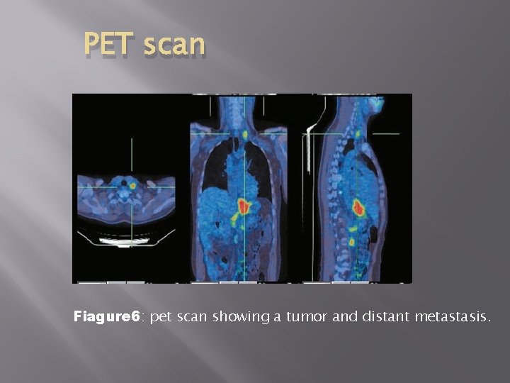 PET scan Fiagure 6: pet scan showing a tumor and distant metastasis. 