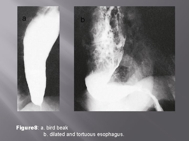 a b Figure 8: a. bird beak b. dilated and tortuous esophagus. 
