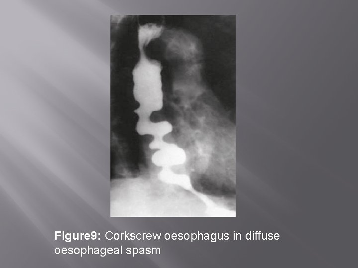 Figure 9: Corkscrew oesophagus in diffuse oesophageal spasm 