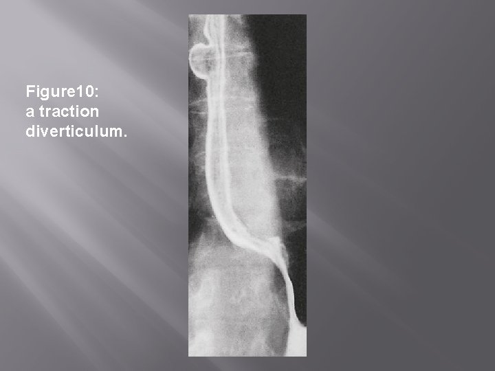 Figure 10: a traction diverticulum. 