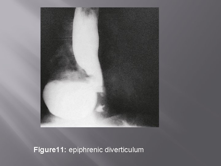 Figure 11: epiphrenic diverticulum 