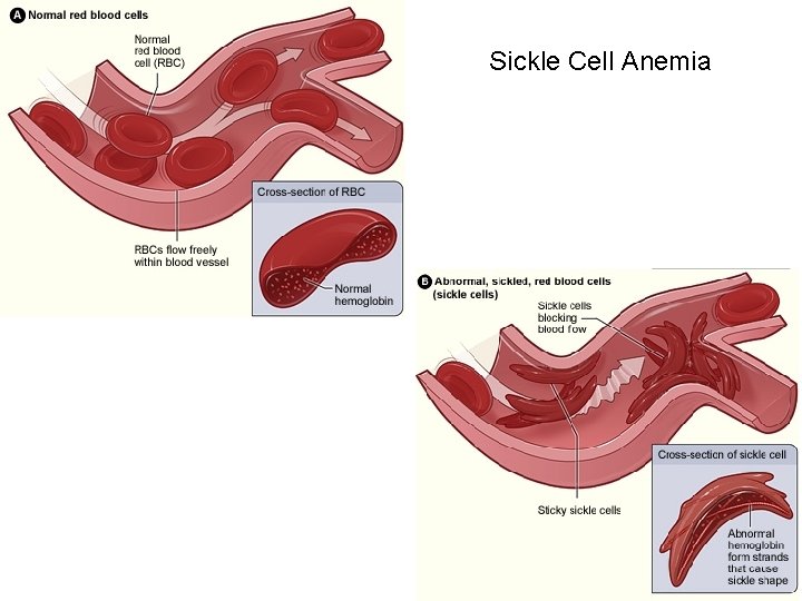 Sickle Cell Anemia 