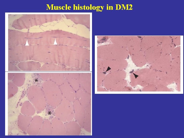 Muscle histology in DM 2 