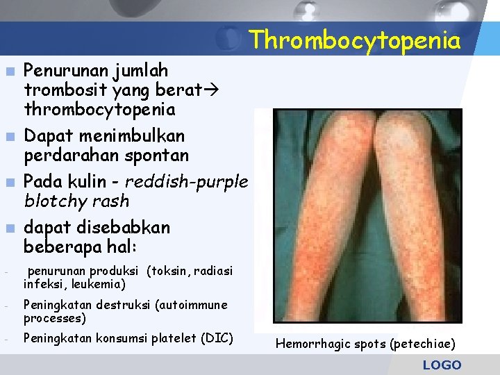 Thrombocytopenia n n Penurunan jumlah trombosit yang berat thrombocytopenia Dapat menimbulkan perdarahan spontan Pada