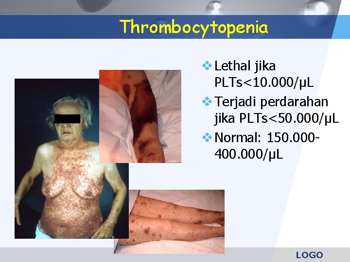 Thrombocytopenia Lethal jika PLTs<10. 000/µL Terjadi perdarahan jika PLTs<50. 000/µL Normal: 150. 000400. 000/µL