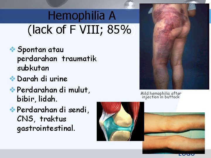 Hemophilia A (lack of F VIII; 85%) Spontan atau perdarahan traumatik subkutan Darah di