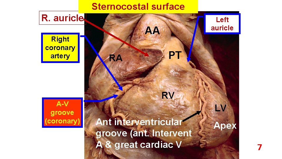 Sternocostal surface R. auricle Right coronary artery A V groove (coronary) Left auricle AA