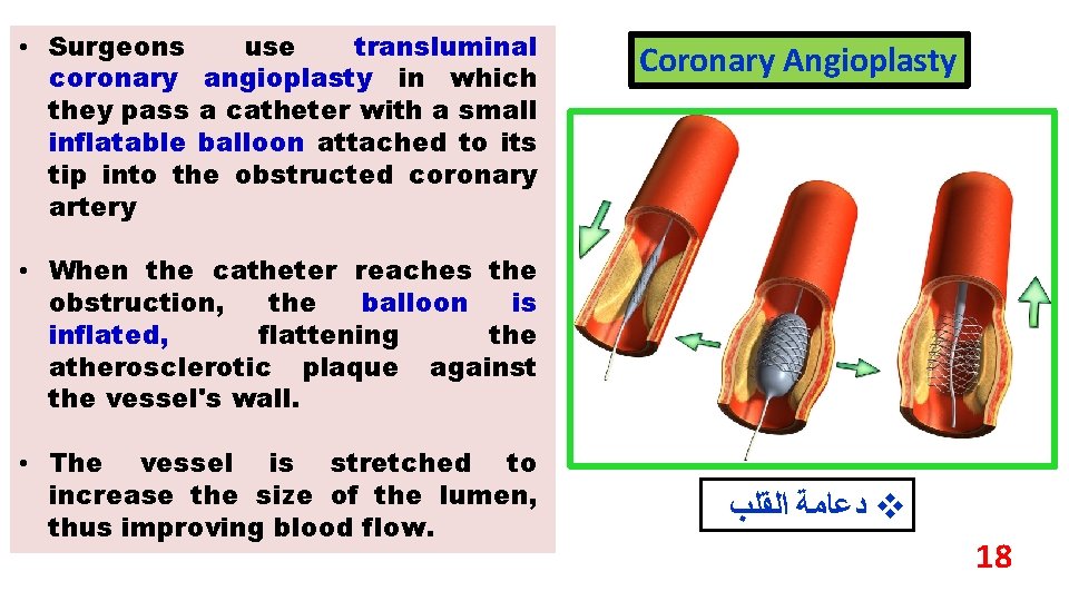  • Surgeons use transluminal coronary angioplasty in which they pass a catheter with