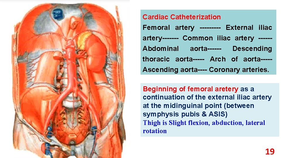 Cardiac Catheterization Femoral artery External iliac artery Common iliac artery Abdominal aorta Descending thoracic