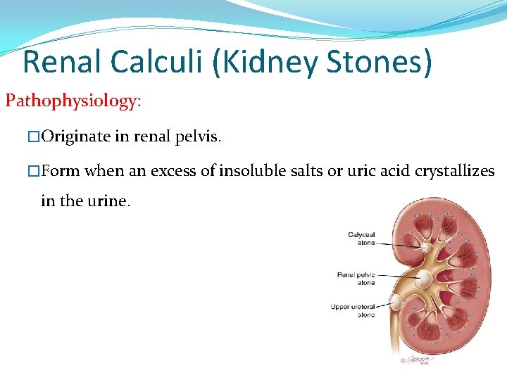 Renal Calculi (Kidney Stones) Pathophysiology: �Originate in renal pelvis. �Form when an excess of