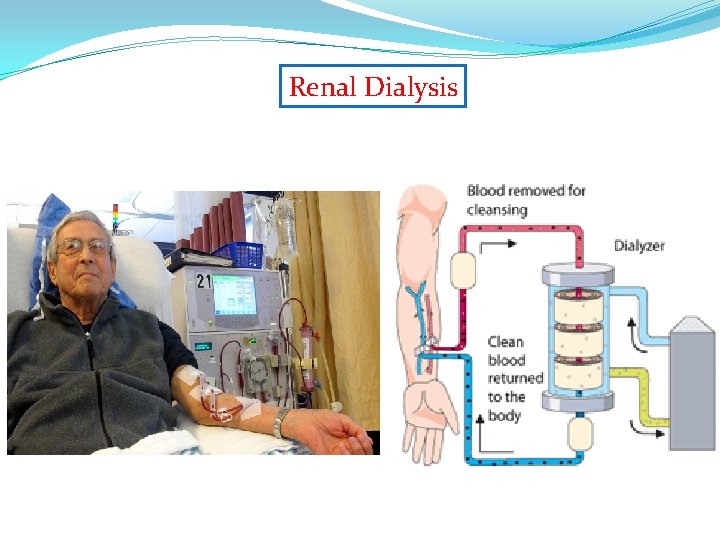 Renal Dialysis 