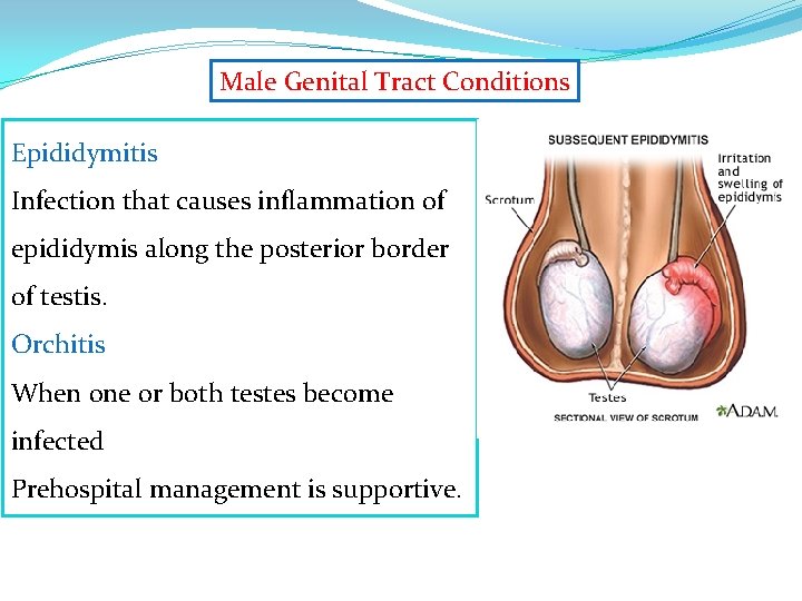 Male Genital Tract Conditions Epididymitis Infection that causes inflammation of epididymis along the posterior