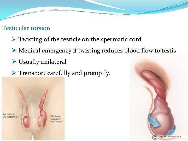 Testicular torsion Ø Twisting of the testicle on the spermatic cord Ø Medical emergency