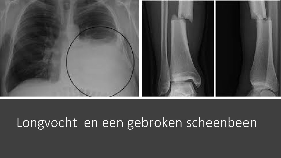 Longvocht en een gebroken scheenbeen 