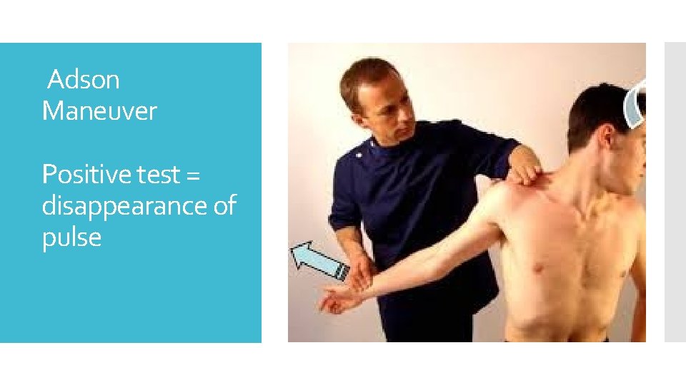 Adson Maneuver Positive test = disappearance of pulse 