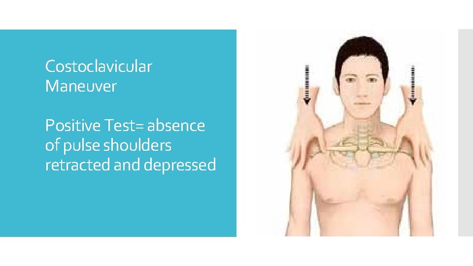 Costoclavicular Maneuver Positive Test= absence of pulse shoulders retracted and depressed 