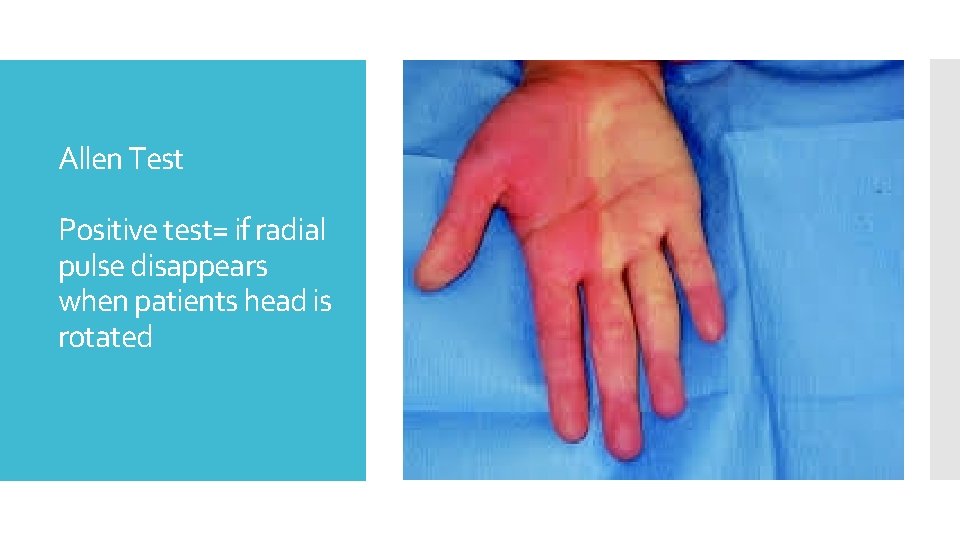 Allen Test Positive test= if radial pulse disappears when patients head is rotated 