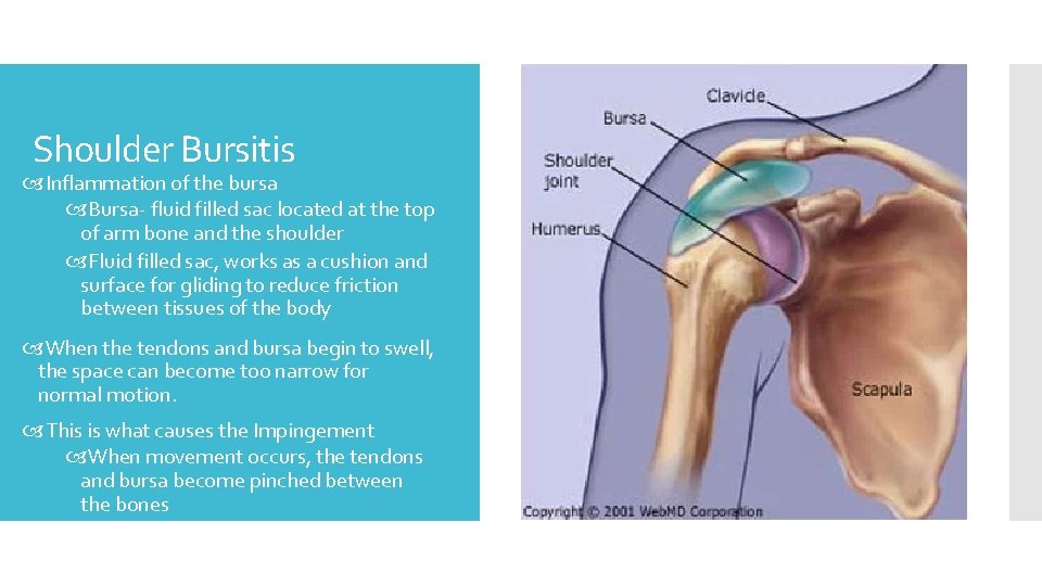 Shoulder Bursitis Inflammation of the bursa Bursa- fluid filled sac located at the top