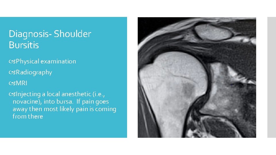 Diagnosis- Shoulder Bursitis Physical examination Radiography MRI Injecting a local anesthetic (i. e. ,