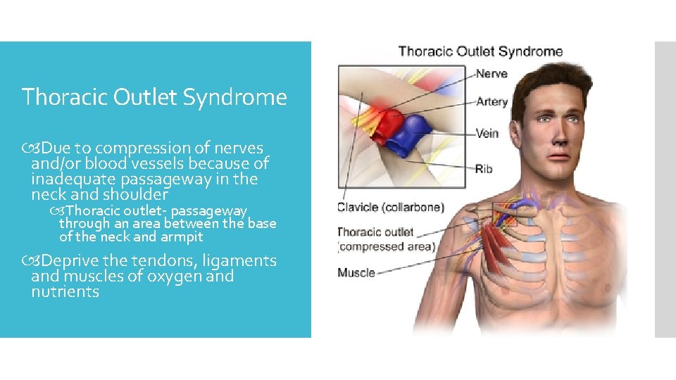 Thoracic Outlet Syndrome Due to compression of nerves and/or blood vessels because of inadequate
