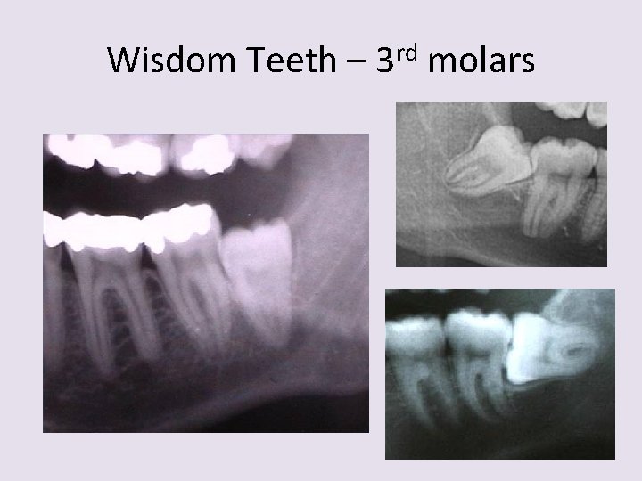 Wisdom Teeth – 3 rd molars 