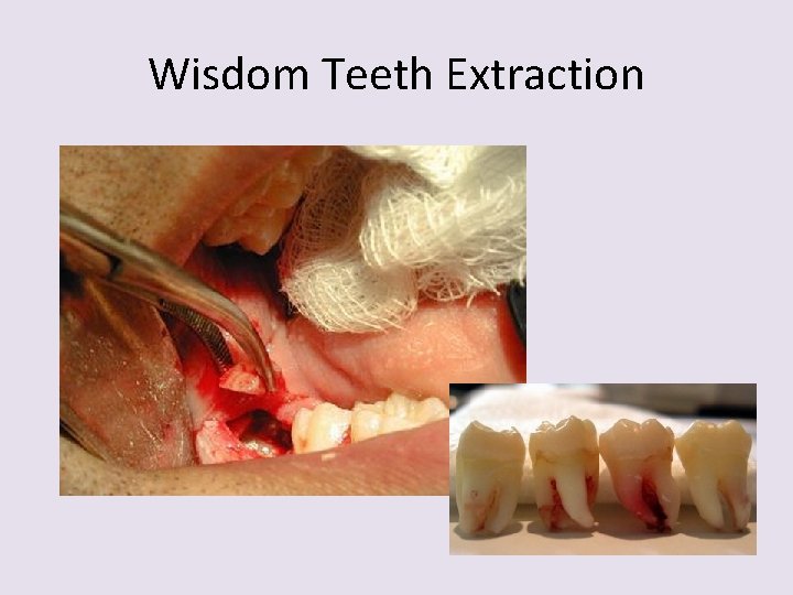 Wisdom Teeth Extraction 