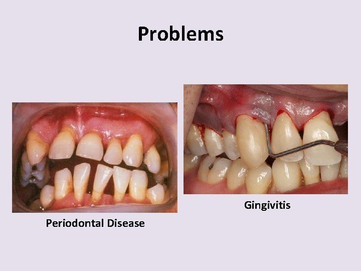 Problems Gingivitis Periodontal Disease 