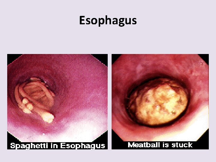 Esophagus 