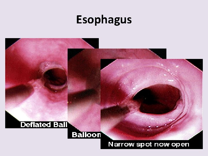 Esophagus 