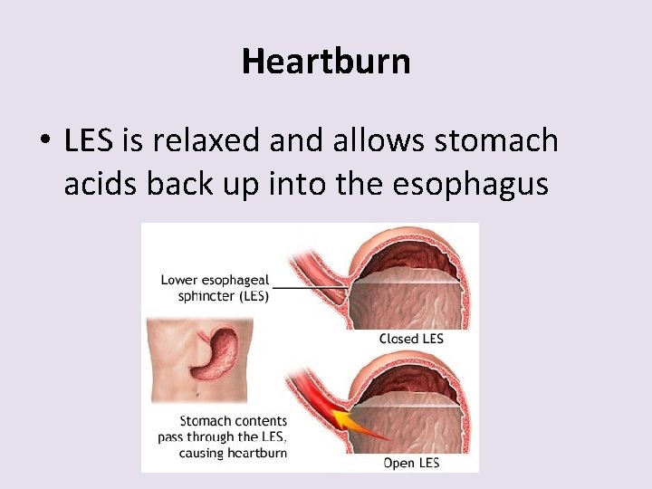 Heartburn • LES is relaxed and allows stomach acids back up into the esophagus