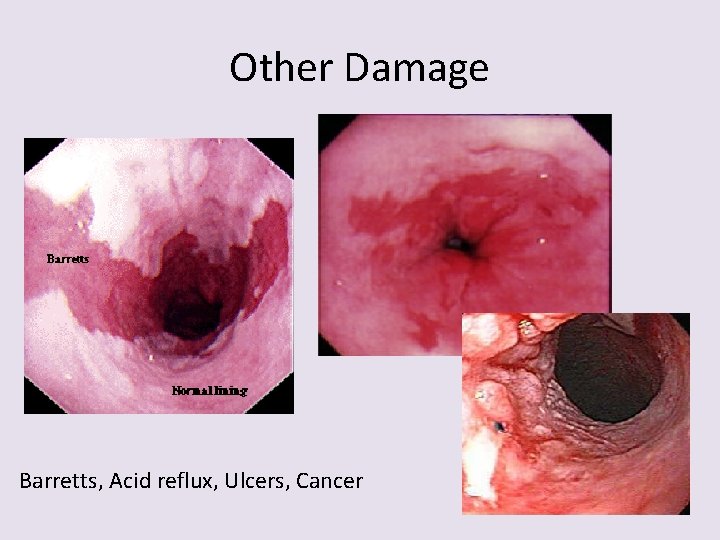 Other Damage Barretts, Acid reflux, Ulcers, Cancer 