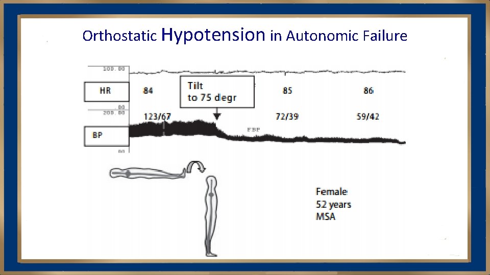 Orthostatic Hypotension in Autonomic Failure 