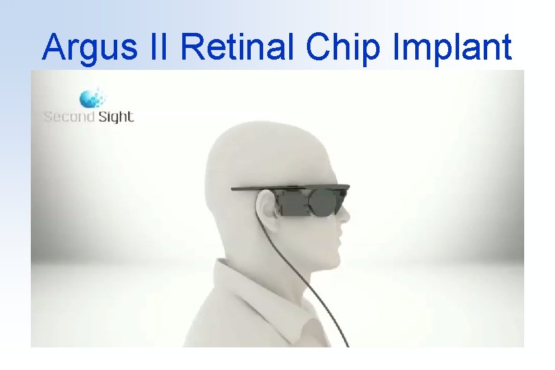 Argus II Retinal Chip Implant 