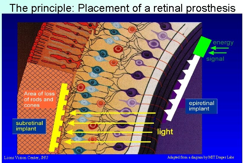 The principle: Placement of a retinal prosthesis Lions Vision Center, JHU Adapted from a