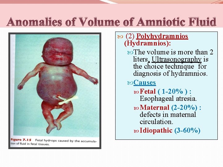 Anomalies of Volume of Amniotic Fluid (2) Polyhydramnios (Hydramnios): The volume is more than