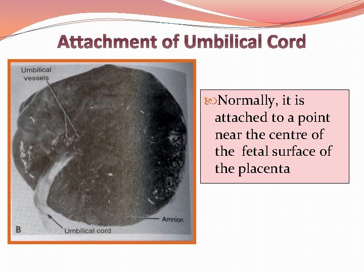 Attachment of Umbilical Cord Normally, it is attached to a point near the centre