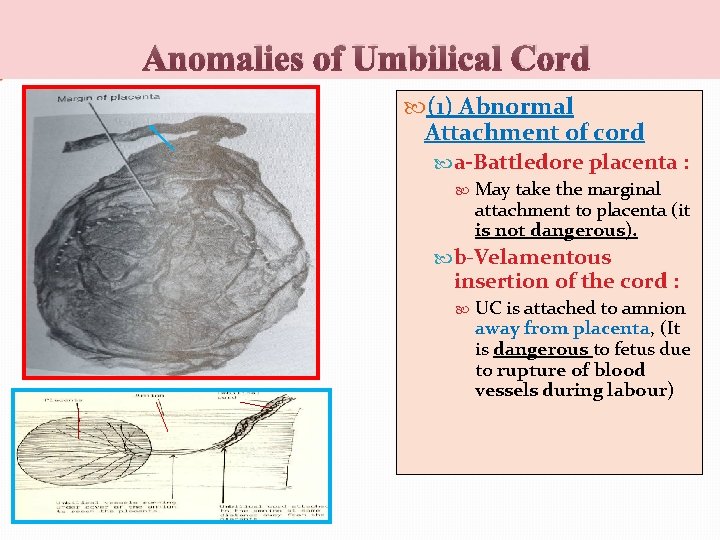 Anomalies of Umbilical Cord (1) Abnormal Attachment of cord a-Battledore placenta : May take