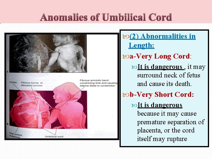 Anomalies of Umbilical Cord (2) Abnormalities in Length: a-Very Long Cord: It is dangerous