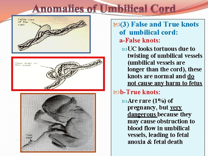 Anomalies of Umbilical Cord (3) False and True knots of umbilical cord: a-False knots: