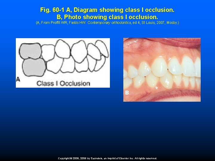 Fig. 60 -1 A, Diagram showing class I occlusion. B, Photo showing class I
