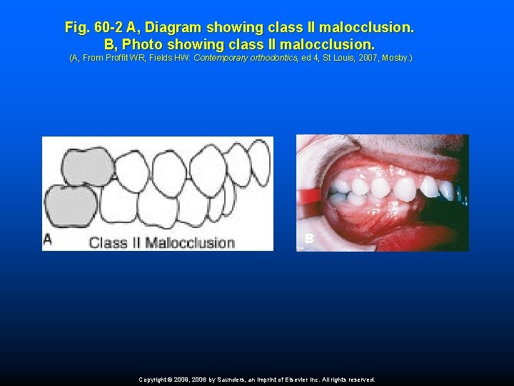 Fig. 60 -2 A, Diagram showing class II malocclusion. B, Photo showing class II