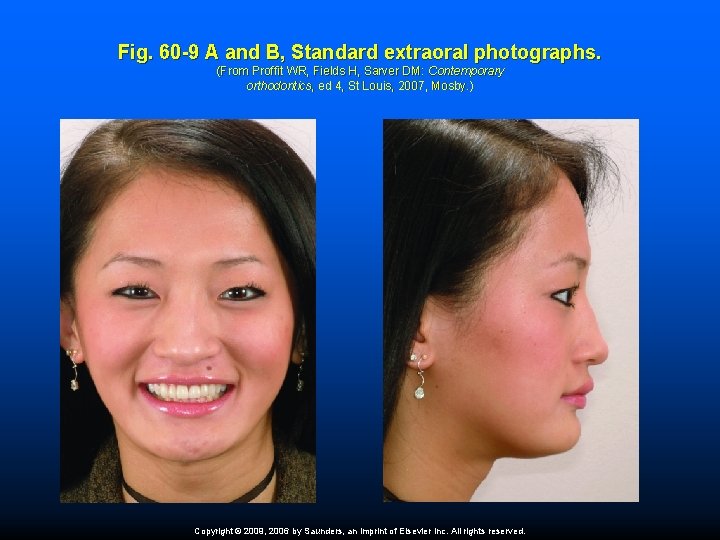 Fig. 60 -9 A and B, Standard extraoral photographs. (From Proffit WR, Fields H,
