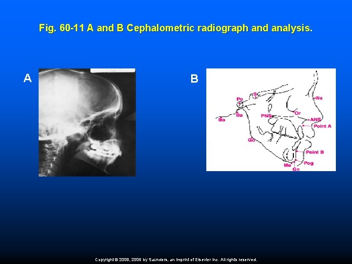 Fig. 60 -11 A and B Cephalometric radiograph and analysis. A B Copyright ©