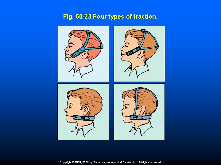 Fig. 60 -23 Four types of traction. Copyright © 2009, 2006 by Saunders, an