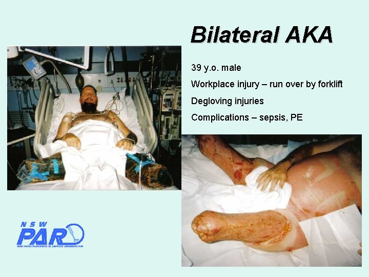 Bilateral AKA 39 y. o. male Workplace injury – run over by forklift Degloving