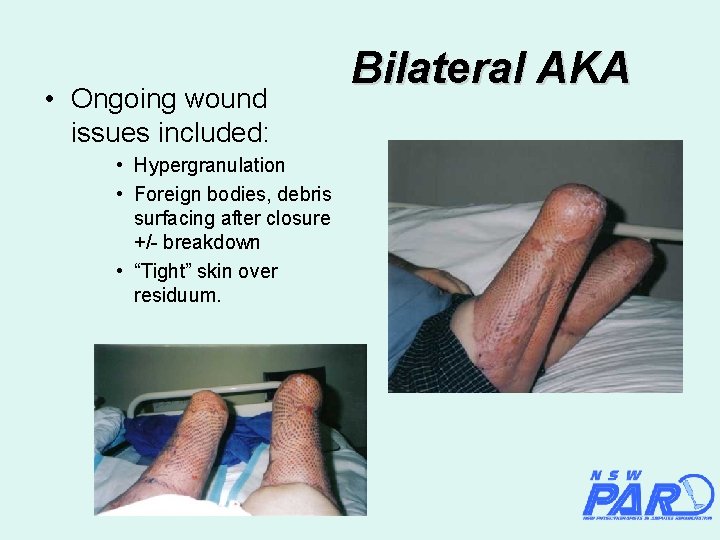  • Ongoing wound issues included: • Hypergranulation • Foreign bodies, debris surfacing after