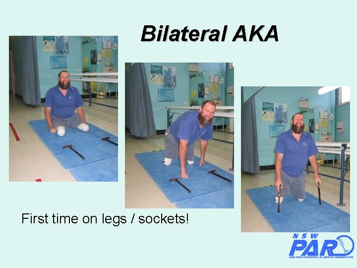 Bilateral AKA First time on legs / sockets! 