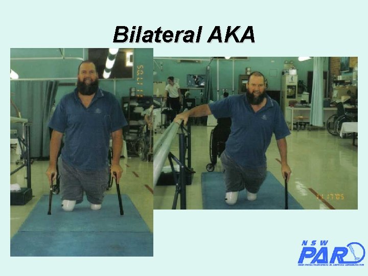 Bilateral AKA 