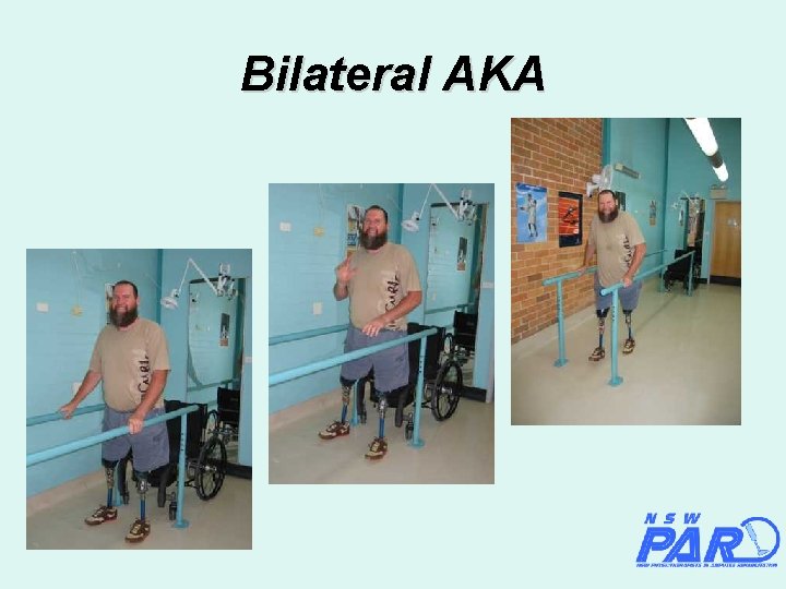Bilateral AKA 